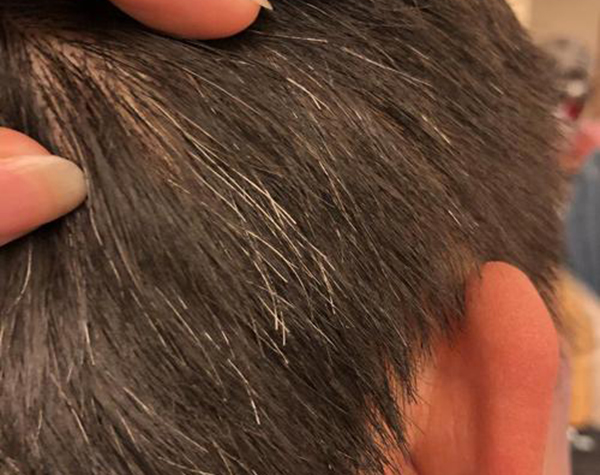 什么是營養(yǎng)性灰白發(fā)？