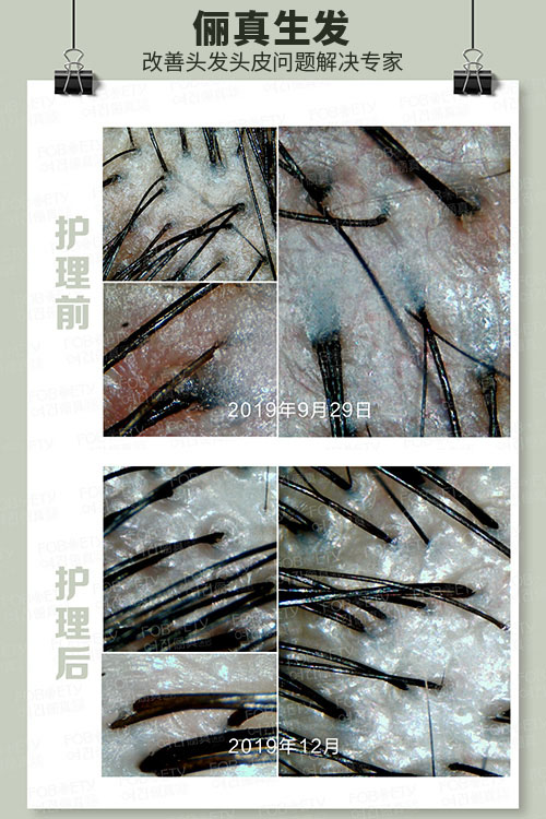 頭油、頭癢